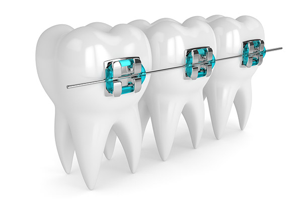 How an Orthodontist Fixes Crowded Teeth With Braces from Smile By Dr. K in Chatsworth, CA