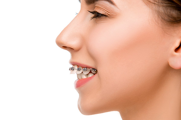 Orthodontist Treatment Options for an Overbite from Smile By Dr. K in Chatsworth, CA